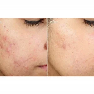 Murad invisiscar™ resurfacing treatment / tratamiento facial de murad 15ml