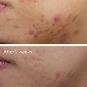 Deep relief acne treatment / tratamiento facial de murad 1 oz