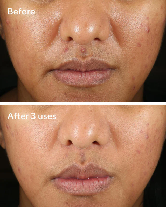 Rapid relief acne sulfur mask / mascarilla reparadora de hidratación celular 74ml