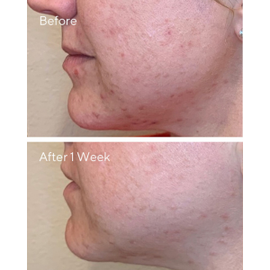 AHA/BHA/Retinoid Daily Clarifying Peel