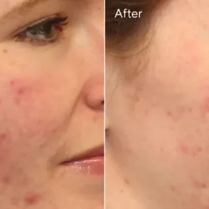 Acne Control Clarifying Cleanser