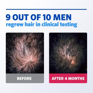 Men’s Rogaine 5% Minoxidil for Men Foam, Clinically Proven Regrowth for Thinning Hair, Topical Hair Loss Treatment, Unscented Topical Aerosol, Results in 8–16 Weeks, 3-Month Supply, 3 x 2.11 oz