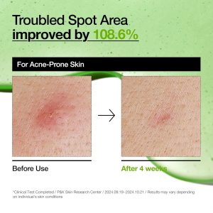 Anua Suero Facial de Ácido Azelaico 10% Hialurónico en Rojo Tranquilizante, Suero Facial para Piel Sensible y Problemática, Brotes, Ácido Hialurónico, Niacinamida, Cuidado de Manchas, Color Natural