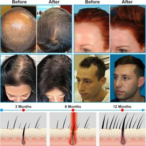 Terapia de luz roja para el crecimiento del cabello Sombrero de luz roja Casco para el crecimiento del cabello Salud del cuero cabelludo