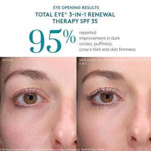 Colorescience Total Eye 3-in-1 Renewal Therapy SPF 35, Broad Spectrum UVA/UVB, Clinically Proven Color Correction & Brightening, Cooling Applicator for Puffiness