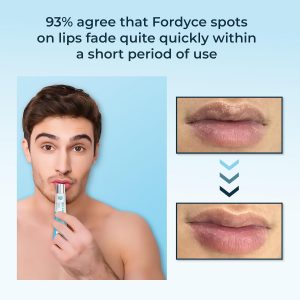 Crema Belani Fordyce – Ayuda a reducir las manchas de Fordyce, cuidado labial hidratante diario para labios secos, agrietados y sensibles a la oscuridad con aceite de girasol, extracto de loto y manteca de karité (0.7 onzas)