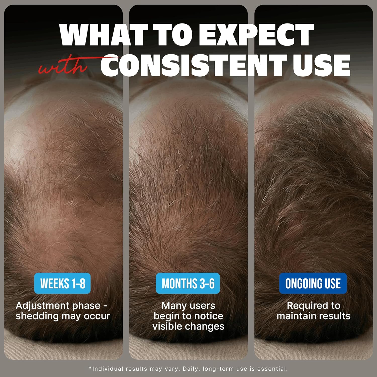 Kirkland Signature Minoxidil Solución tópica USP 5%, tratamiento de crecimiento capilar extra fuerte para hombres, suministro de 6 meses